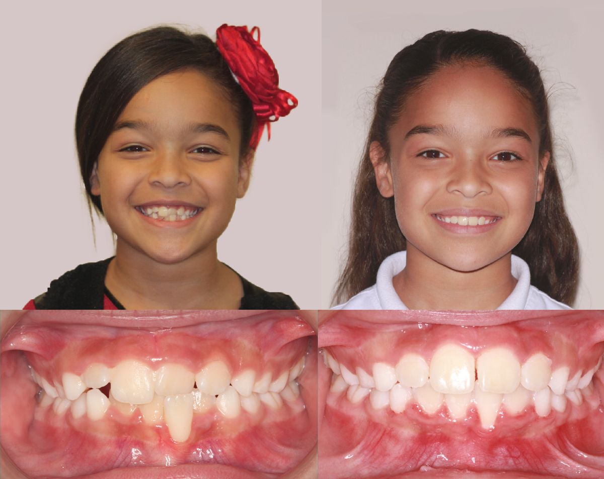 Children's Dentistry at EverSmile